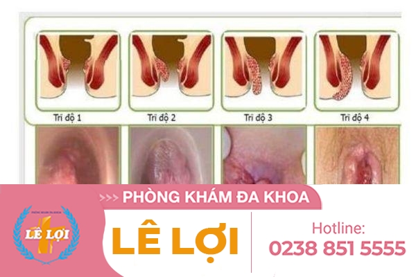 cach-dieu-tri-tri-noi-hieu-qua-dia-chi-uy-tin-3