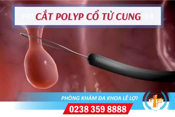 Cắt polyp cổ tử cung có hiệu quả và an toàn không?