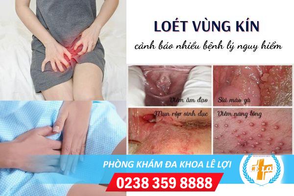 Nguyên nhân gây loét vùng kín và cách chữa trị