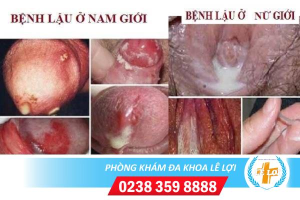 phong-kham-chua-benh-lau-uy-tin-tai-vinh-nghe-an-3
