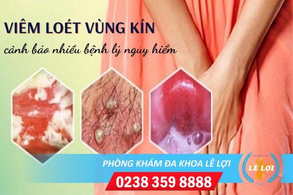 viem-loet-vung-kin-la-dau-hieu-cua-benh-gi (2)