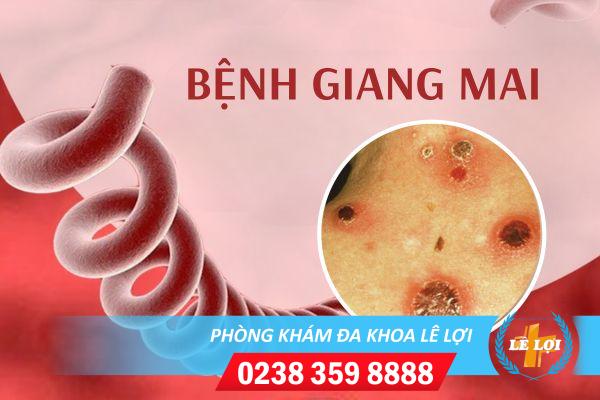Bệnh giang mai là gì nhận biết như thế nào?
