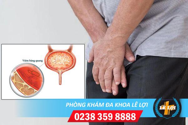Bệnh viêm bàn quan và những kiến thức cần biết