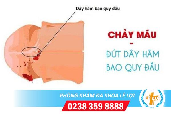 Đứt dây hãm bao quy đầu có sao không?