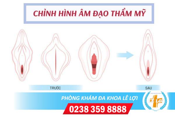 chinh-hinh-am-dao-cach-giup-phai-dep-lay-lai-su-tu-tin-2-1