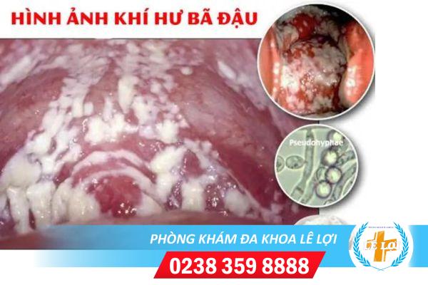 Khí hư huyết trắng trông như bã đậu là bị gì?