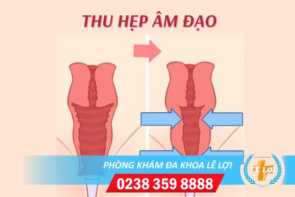 Giá thu hẹp âm đạo bao nhiêu tiền?