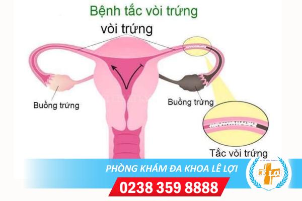 Dấu hiệu viêm tắc vòi trứng và cách điều trị