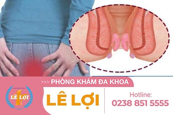 Lòi trĩ phải làm sao?