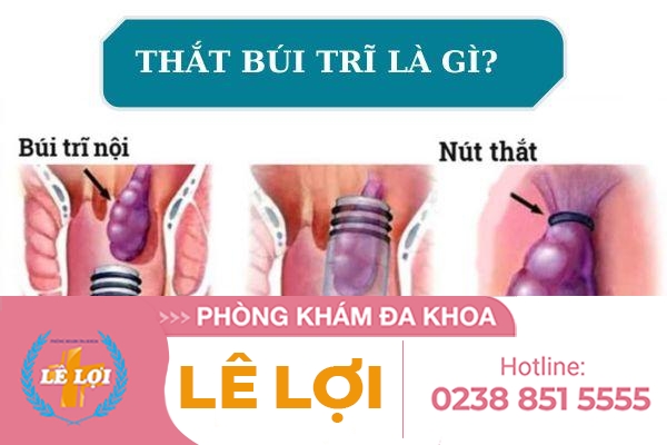 Thắt búi trĩ hiệu quả không?