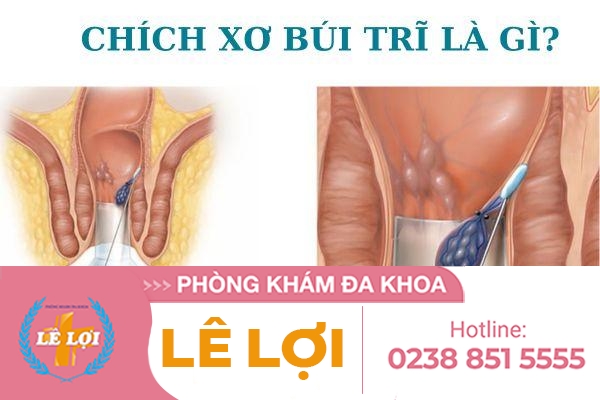Chích xơ búi trĩ có hiệu quả không?