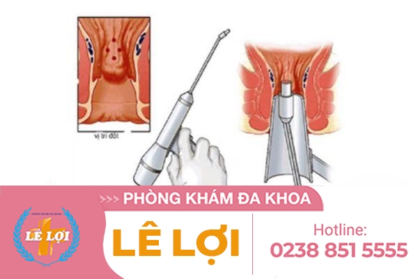 Đốt trĩ hiệu quả không chi phí bao nhiêu?