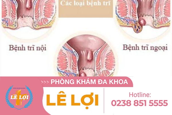 Địa chỉ khám trĩ ngoài giờ – giá không đổi