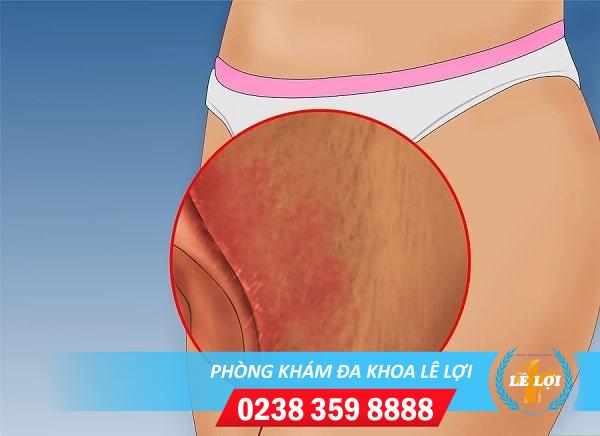 Nổi mẩn đỏ âm đạo nguy hiểm không bị bệnh gì?