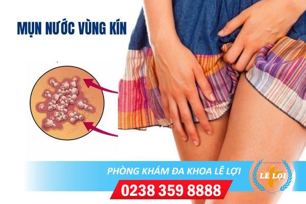 Những thông tin cần biết về mụn nước ở vùng kín