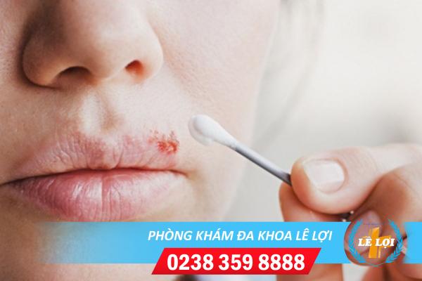 Thông tin về tình trạng mụn nước ở môi