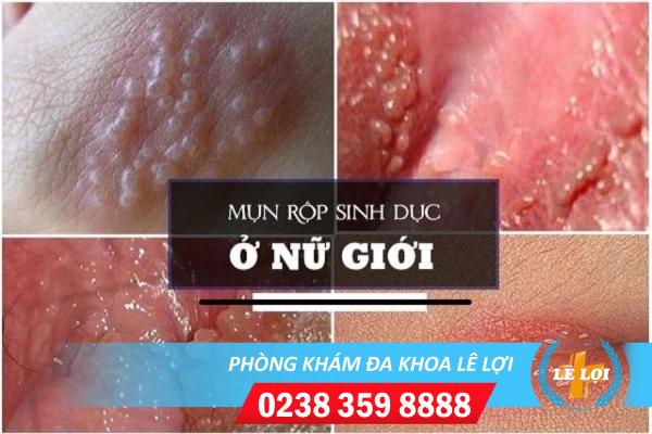 mun-rop-sinh-duc