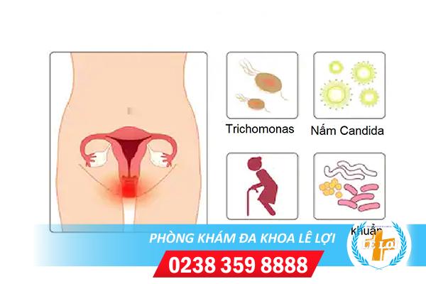 Những điều cần biết về nhiễm khuẩn nhiễm trùng âm đạo