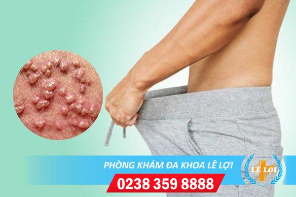 Nổi hạt trắng sinh dục là bị gì?