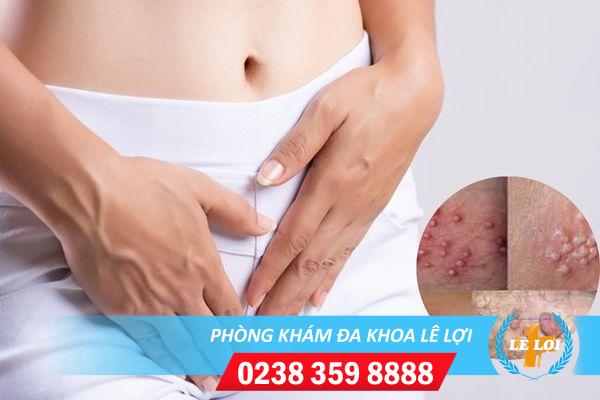 Cảnh giác với tình trạng nổi mụn mủ hột le