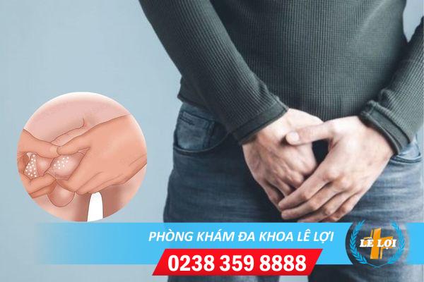 Nổi hạt trắng dương vật cảnh báo nguy hiểm