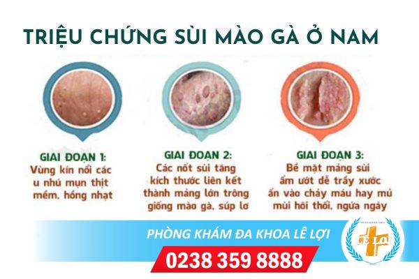 Sùi mào gà ở dương vật nguy hiểm như thế nào?