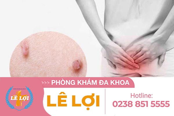 Nguyên nhân gây ra da thừa, thịt thừa ở hậu môn