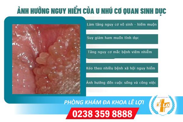 u-nhu-co-quan-sinh-duc-1