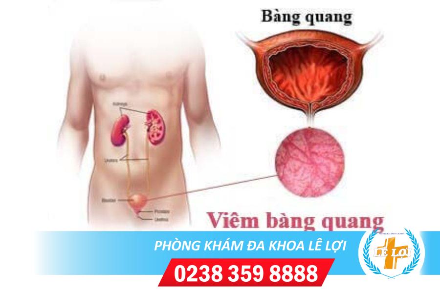 Cách chữa viêm bàng quang tại nhà hiệu quả
