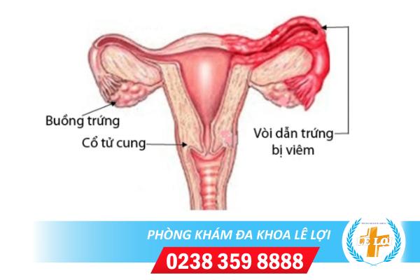 Viêm ống dẫn trứng: Nguyên nhân, dấu hiệu và cách điều trị
