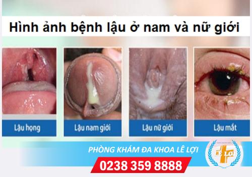 benh-lau (1)