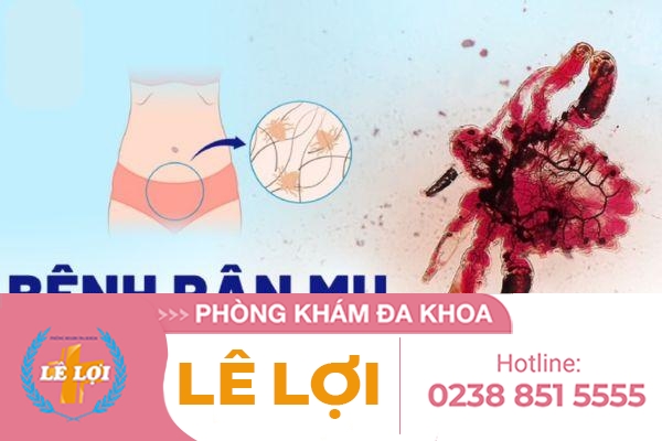 Rận mu là bệnh gì nguy hiểm không?