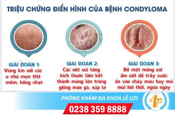 Bệnh condyloma biểu hiện và cách điều trị