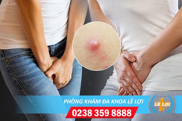 Tìm hiểu nguyên nhân gây nổi mụn nhọt ở bẹn