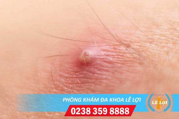 Mụn nhọt vùng kín là bị bệnh gì?