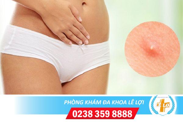 Nguyên nhân gây mụn vùng kín và cách điều trị