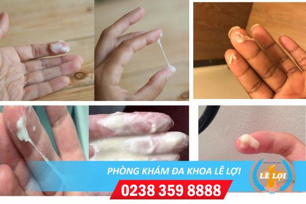 Nguyên nhân dịch âm đạo có mùi hôi và cách điều trị