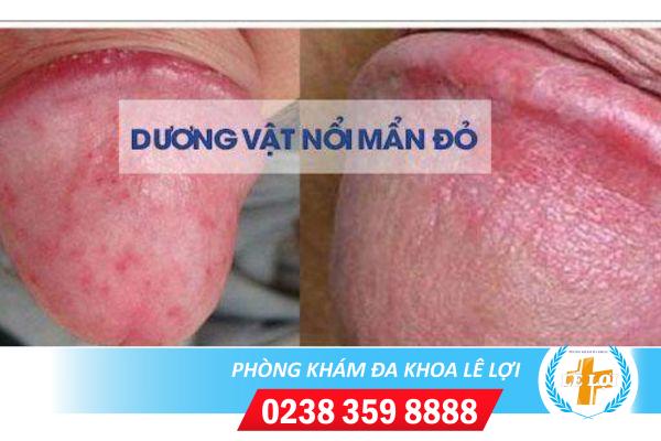Nguyên nhân và cách xử lý chim nổi mẩn đỏ
