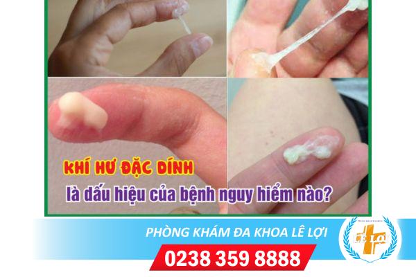 Khí hư huyết trắng dính như keo nguy hiểm không?