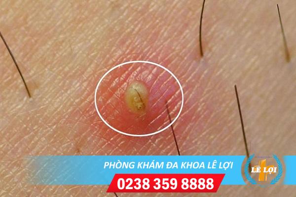 Tại sao bị nổi mụn mủ âm đạo?