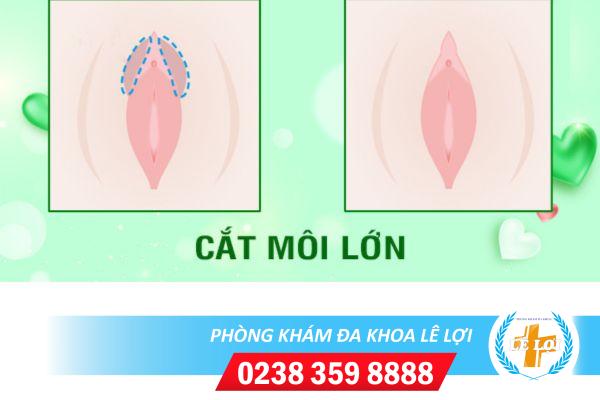 Cắt môi lớn ở đâu? có đắt không?