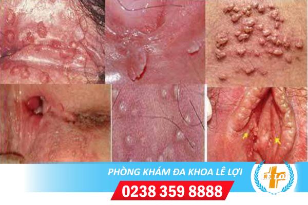 Biến chứng nguy hiểm của mụn nước âm đạo