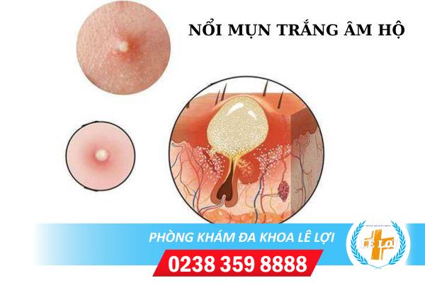Nổi mụn trắng âm hộ và những tác hại nguy hiểm