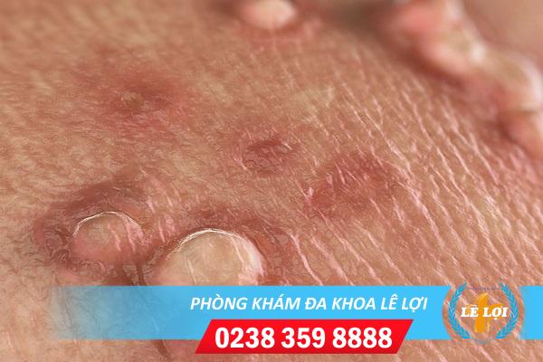 Tìm hiểu về căn bệnh mụn cơm vùng kín