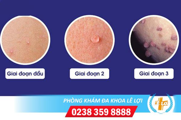Triệu chứng và tác hại của mụn cơm sinh dục