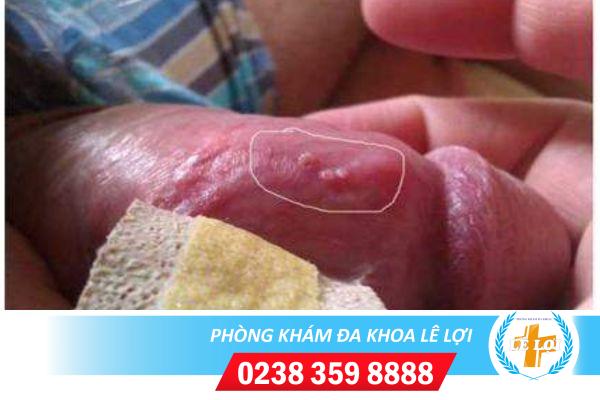 Nổi mụn đầu trắng dương vật là bị bệnh gì?