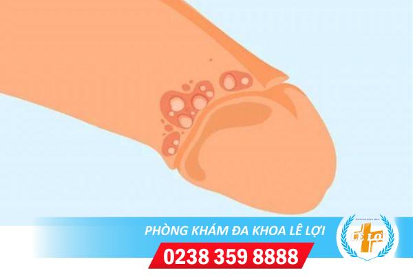 Nổi mụn mủ dương vật là bị bệnh gì?