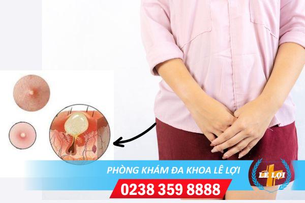 Cách chữa mụn vùng kín hiệu quả an toàn