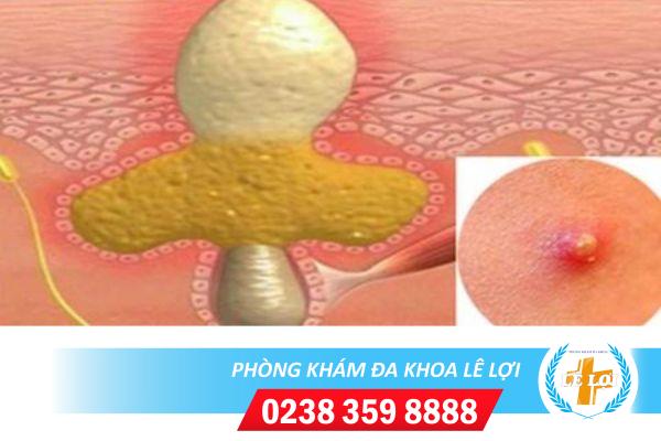Nguy hiểm khôn lường khi nổi mụn mủ vùng kín
