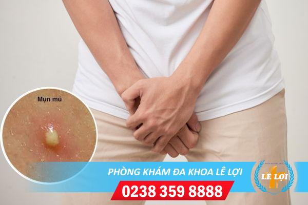 Nổi mụn mủ bao quy đầu và cách xử lý